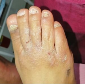 DERMATOMICOSIS 2