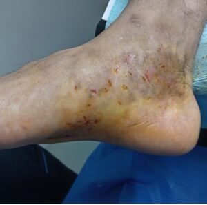 DERMATOMICOSIS 3