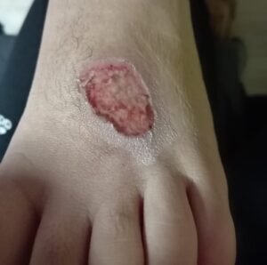HERIDAS ULCERAS 6