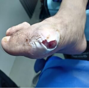 HOLEOMA SEPTICO 8