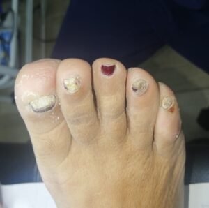 ONICOMICOSIS 11